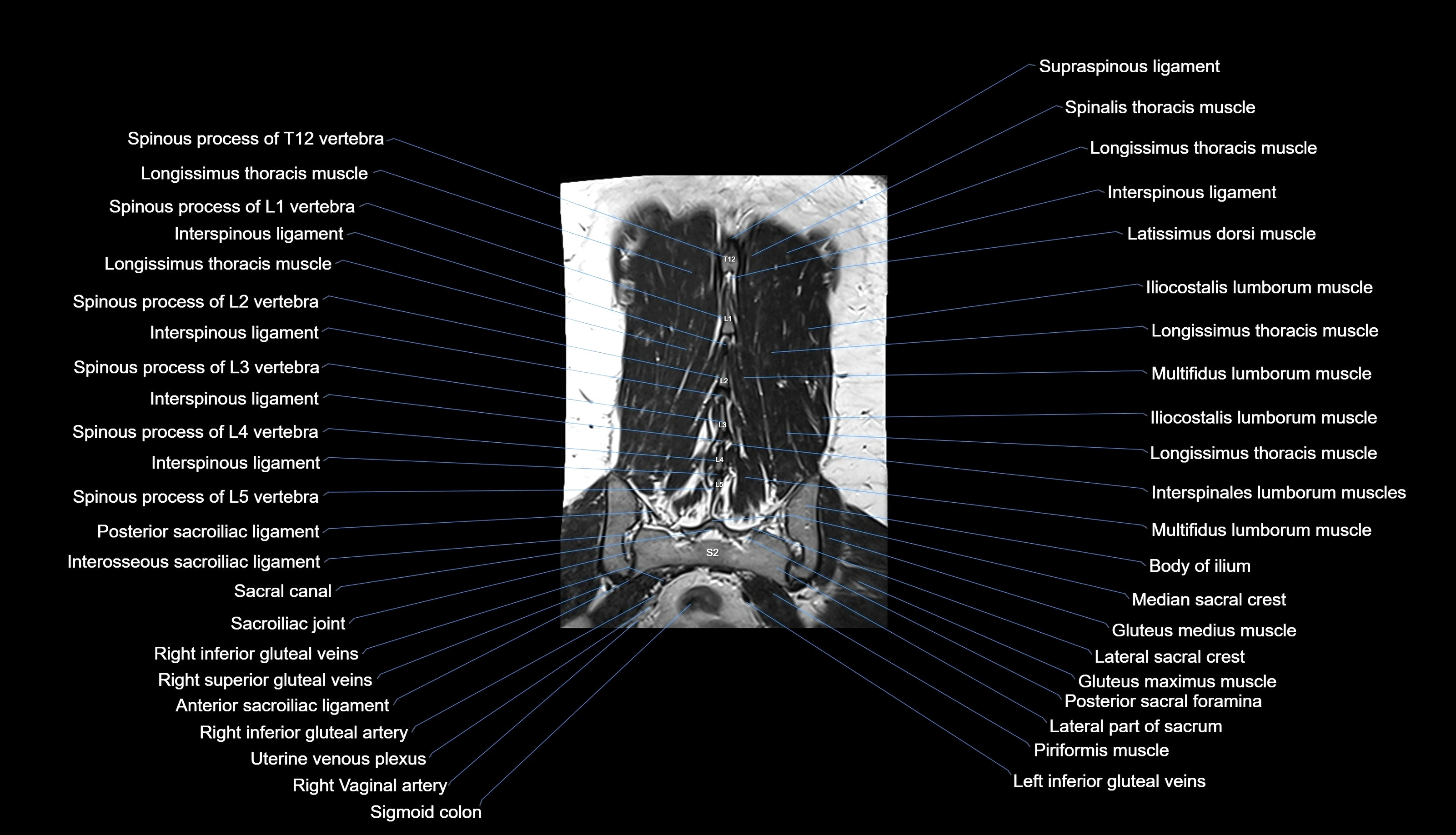 MRI lumbar spine labelled coronal cross sectional anatomy 3T radiology-img-00001-00032.webp